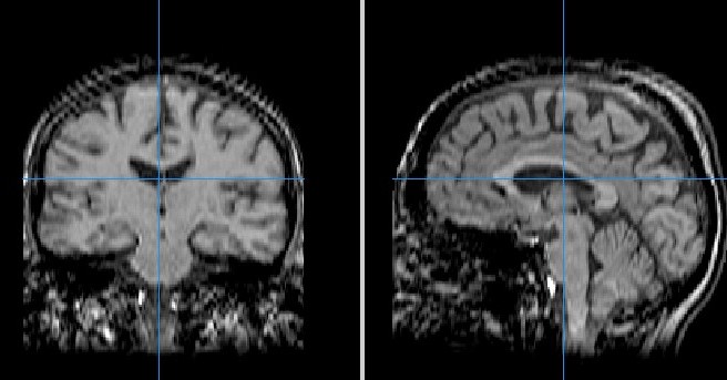 Does Ms Show Up On Ct Scan